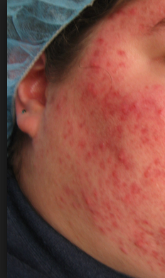 Acne - Chris Byrnes, LLC