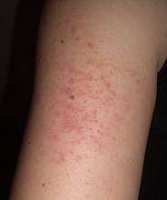 Keratosis Pilaris - Chris Byrnes, LLC