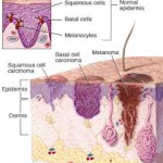 Skin Cancer - Chris Byrnes, LLC