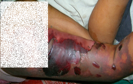 ChrisByrnes.com - Disseminated Intravascular Coagulation 2015