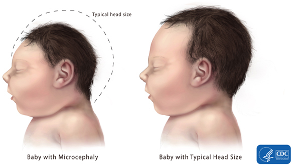 Comparison of a typical baby's head vs. one with Microcephaly