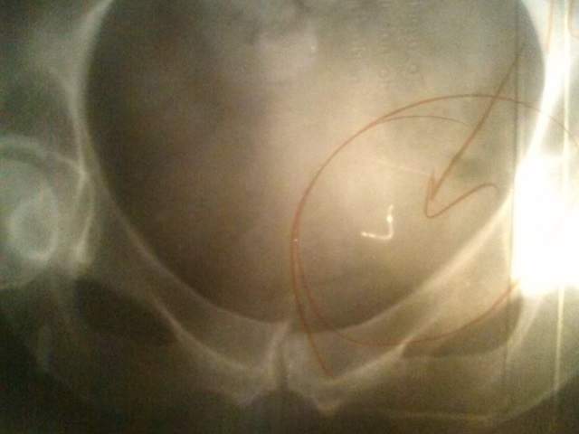 ChrisByrnes.com - X-ray shows Essure in Abdomen ChrisByrnes.com - X-ray shows Essure in Abdomen