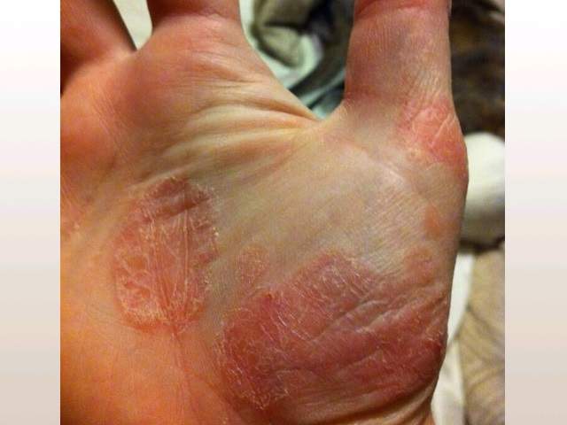 ChrisByrnes.com - Rash from Essure ChrisByrnes.com - Rash from Essure
