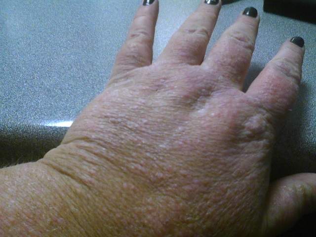 ChrisByrnes.com - Swelling from Complications of Essure ChrisByrnes.com - Swelling from Complications of Essure