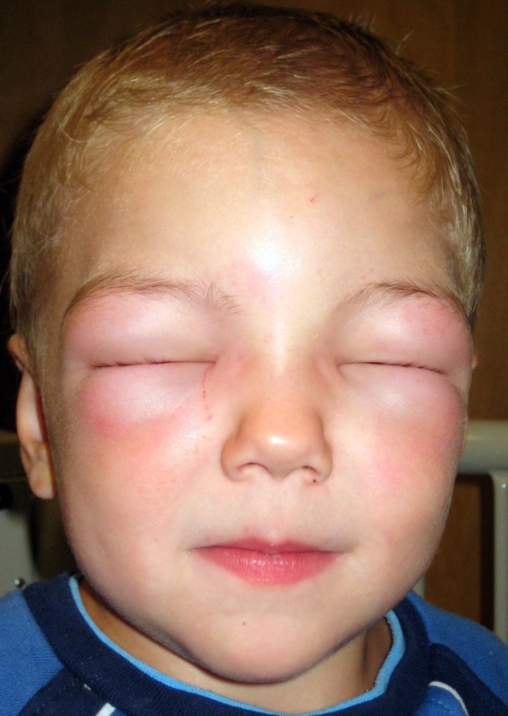 ChrisByrnes.com - Peanut Allergic Reaction in Child